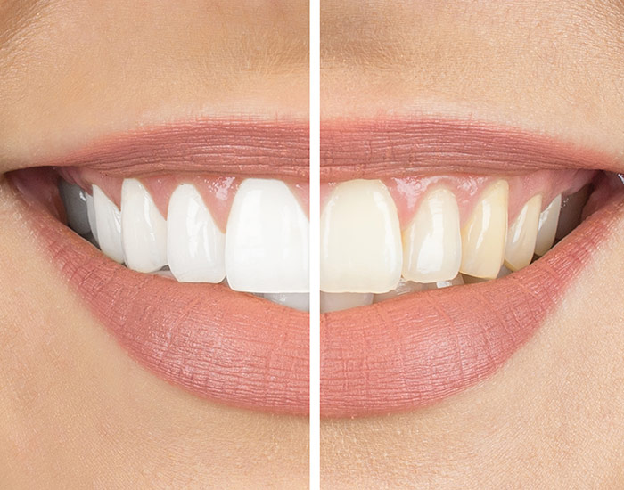 before and after teeth whitening